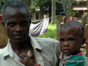 RDC : le nombre de cas de Monkey Pox a triplé en 2023, selon MSF